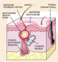 что вы делаете с прыщями?