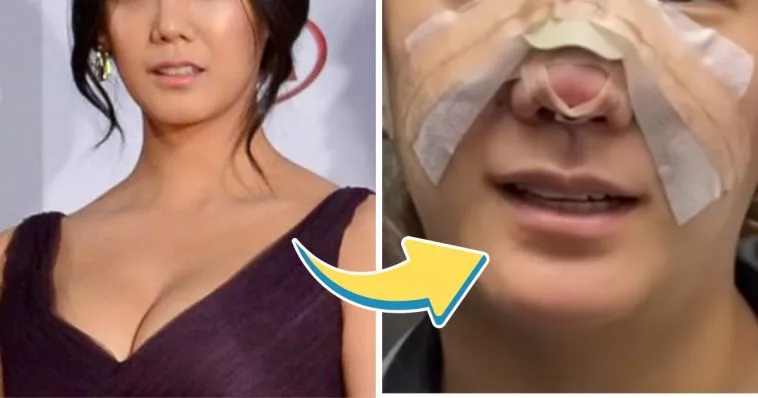 Популярная актриса шокировала поклонников своим "новым" носом после косметической операции, впервые сняв бинты