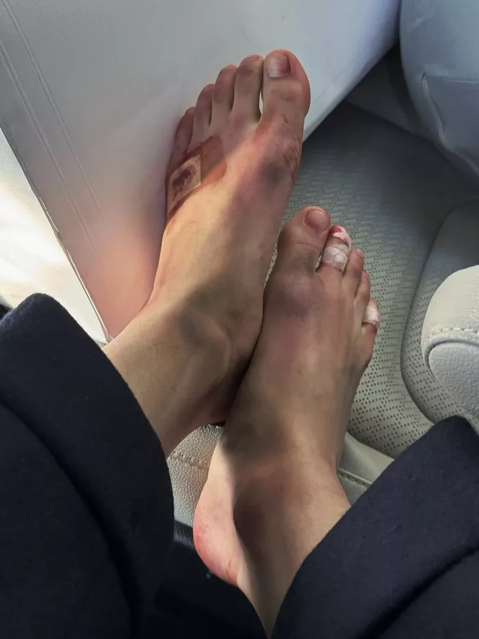 Ренджун из NCT DREAM попал в заголовки новостей, показав свои покрытые ранами ноги